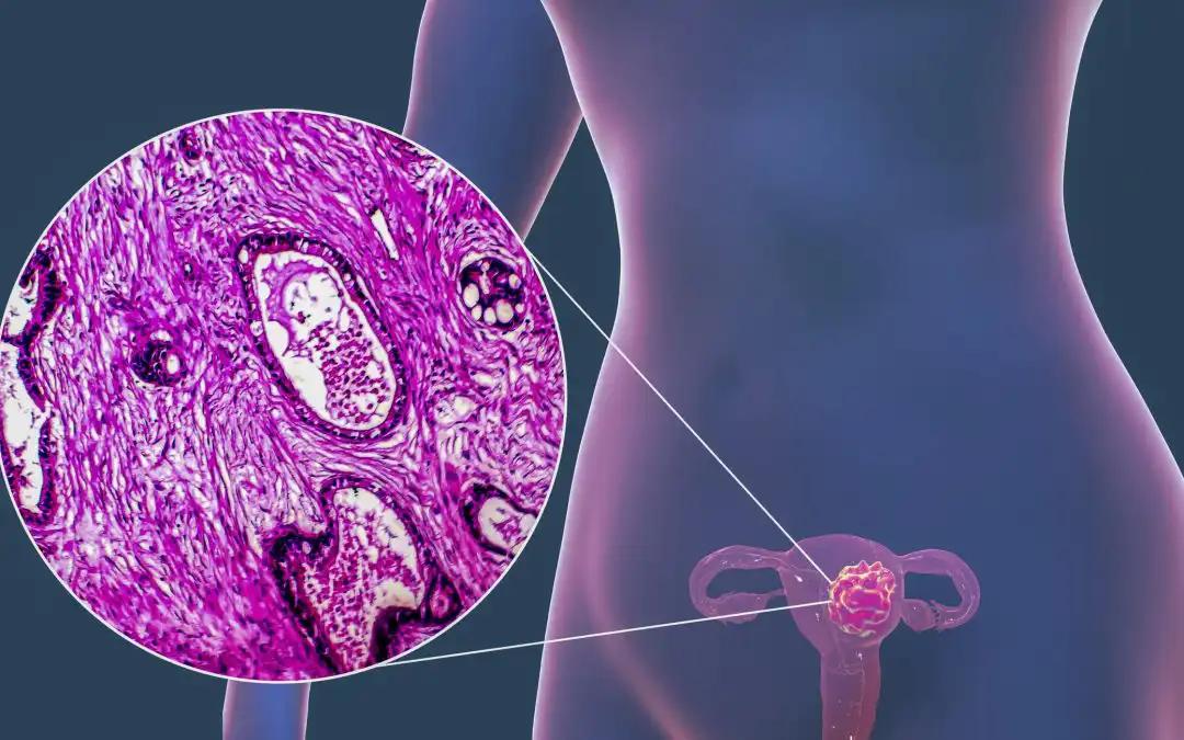 Metabolic Disorders and Clinicopathologic Features in EC