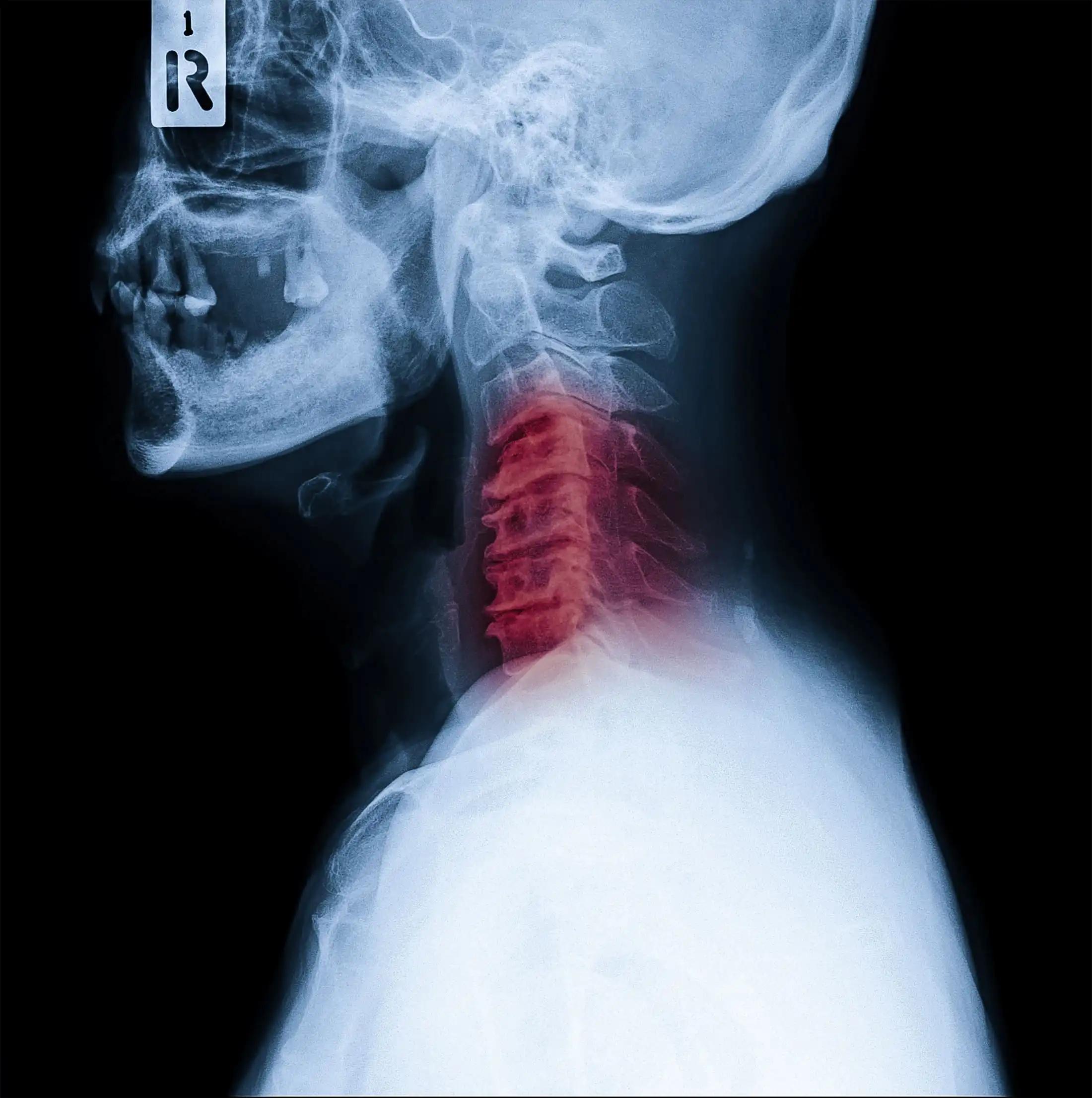 X-ray of Neck and Cervical Spine Show Infusion in Neck