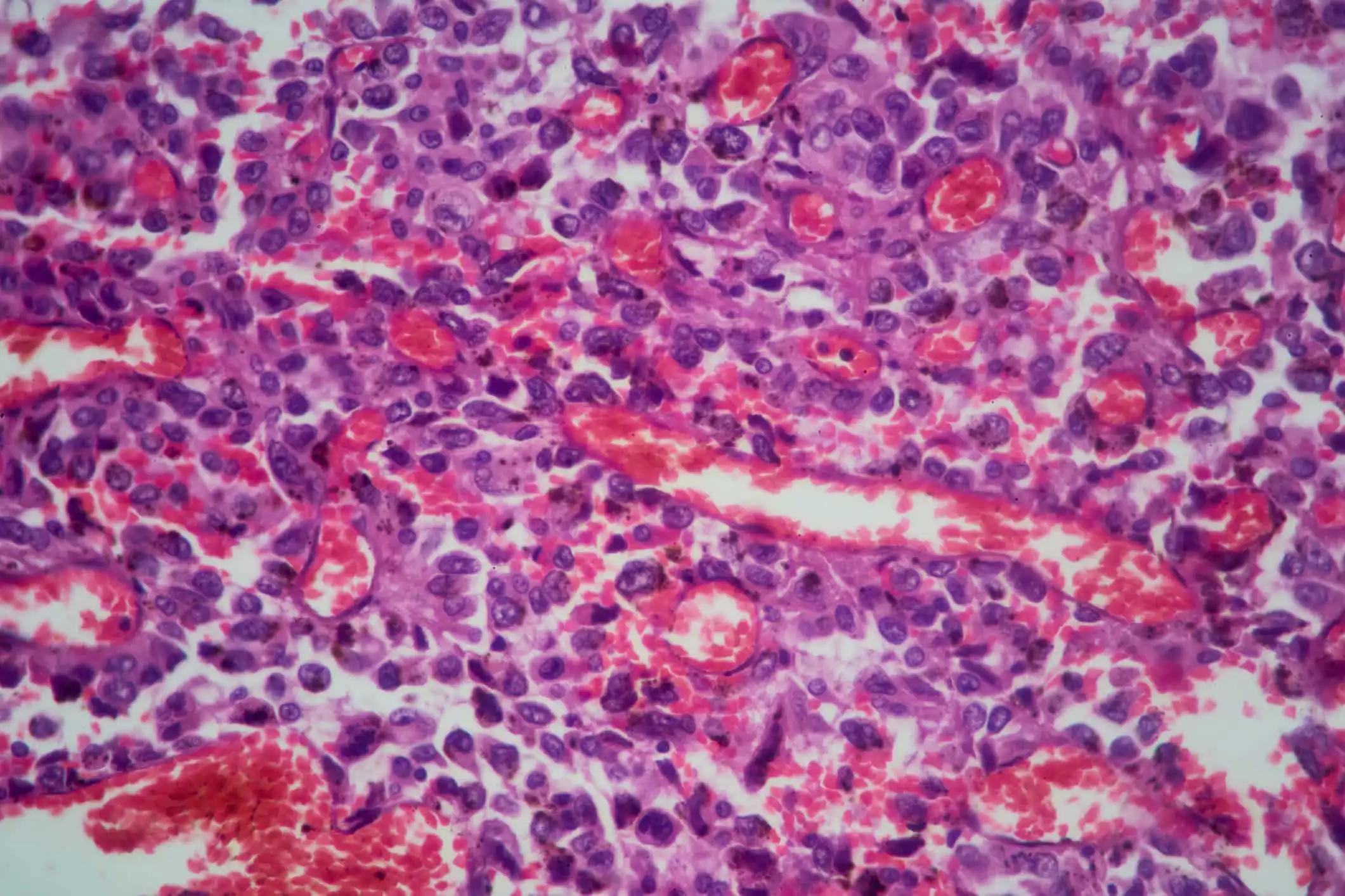 Lung tissue adenocarcinoma with HE stain as seen under a microscope
