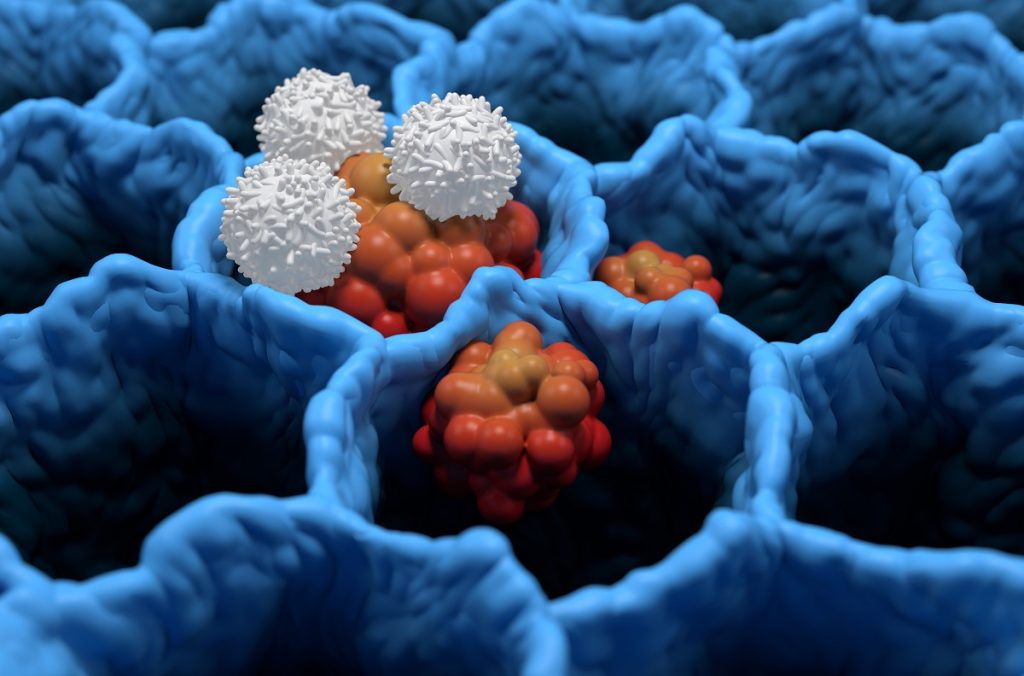 Nivolumab+Chemo For Early Lung Cancer