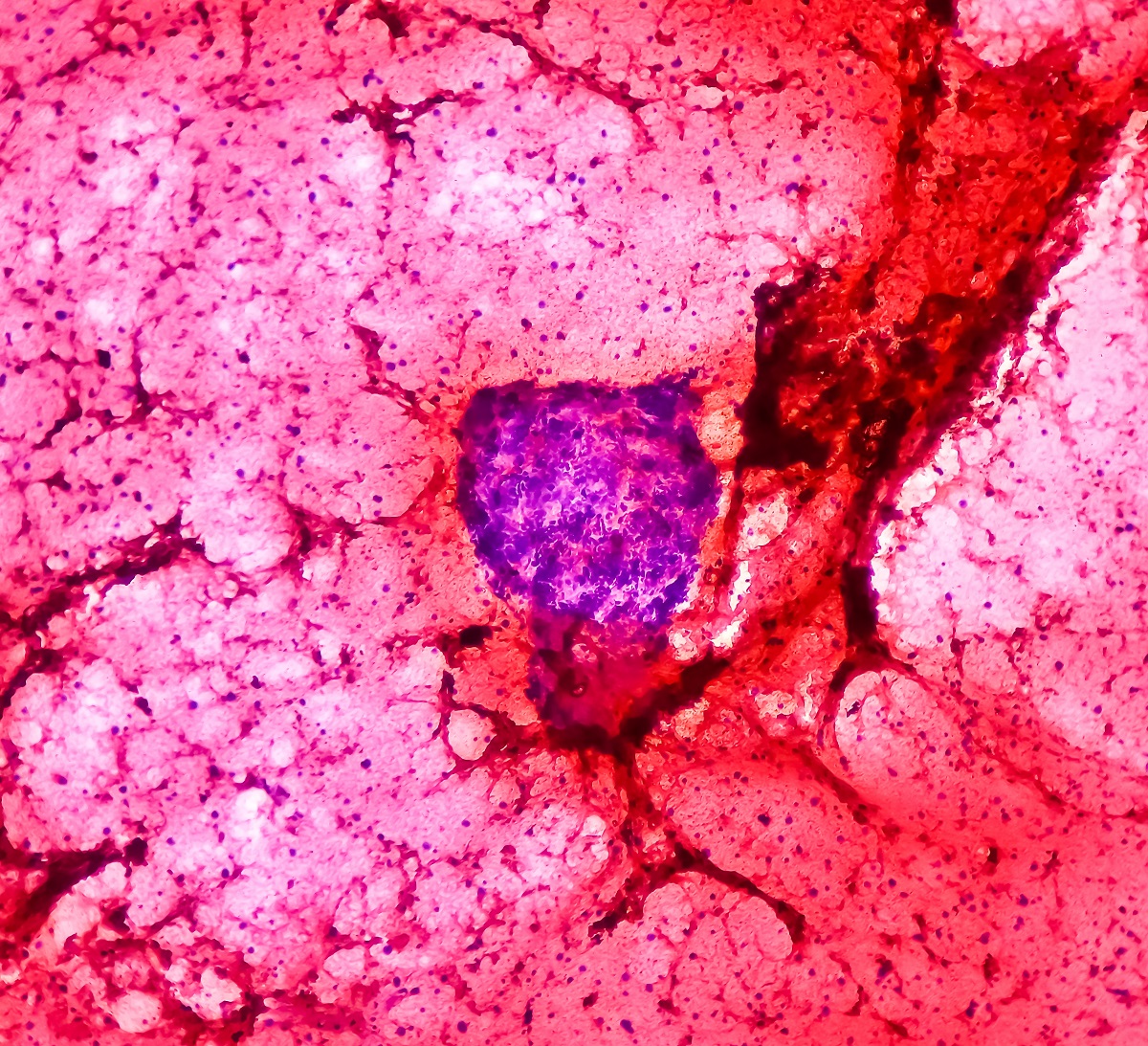 Photomicrograph of Osteolytic Lesion of Left Proximal Radius