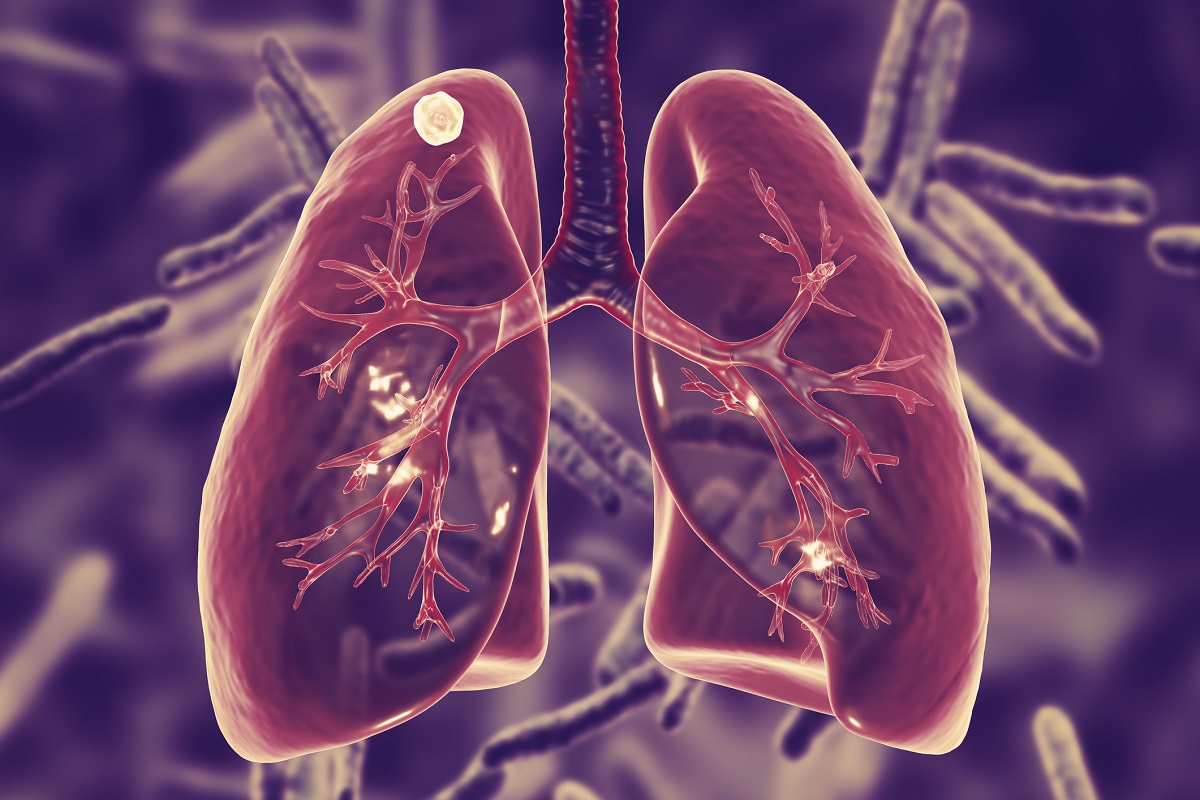 3D illustration of Secondary Tuberculosis in Lungs