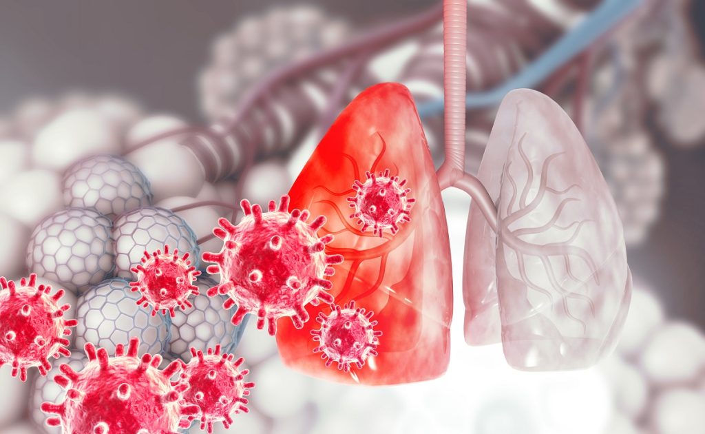 3d illustration of NSCLC Virus Attacking the Lungs