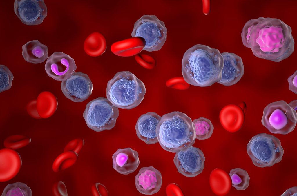 Photomicrograph of Acute Myeloblastic Leukemia Cancer