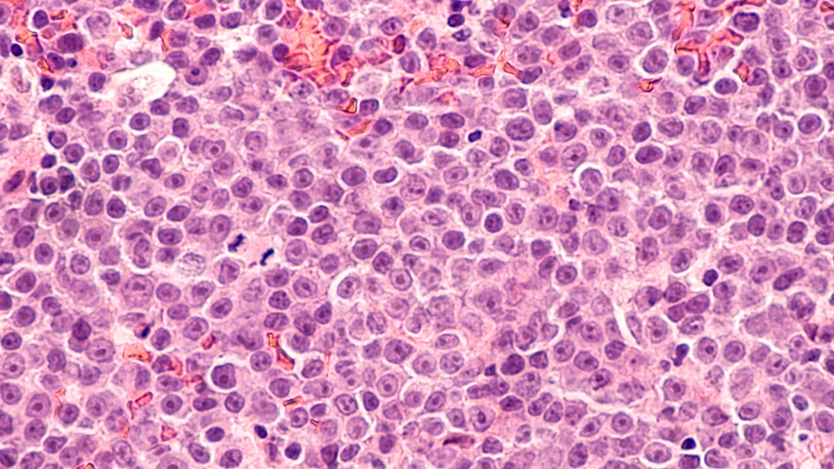 Photomicrograph of Diffuse Large B-Cell Lymphoma