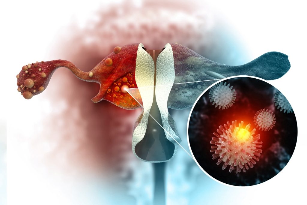 3d illustration of Gynecological Malignant Tumor