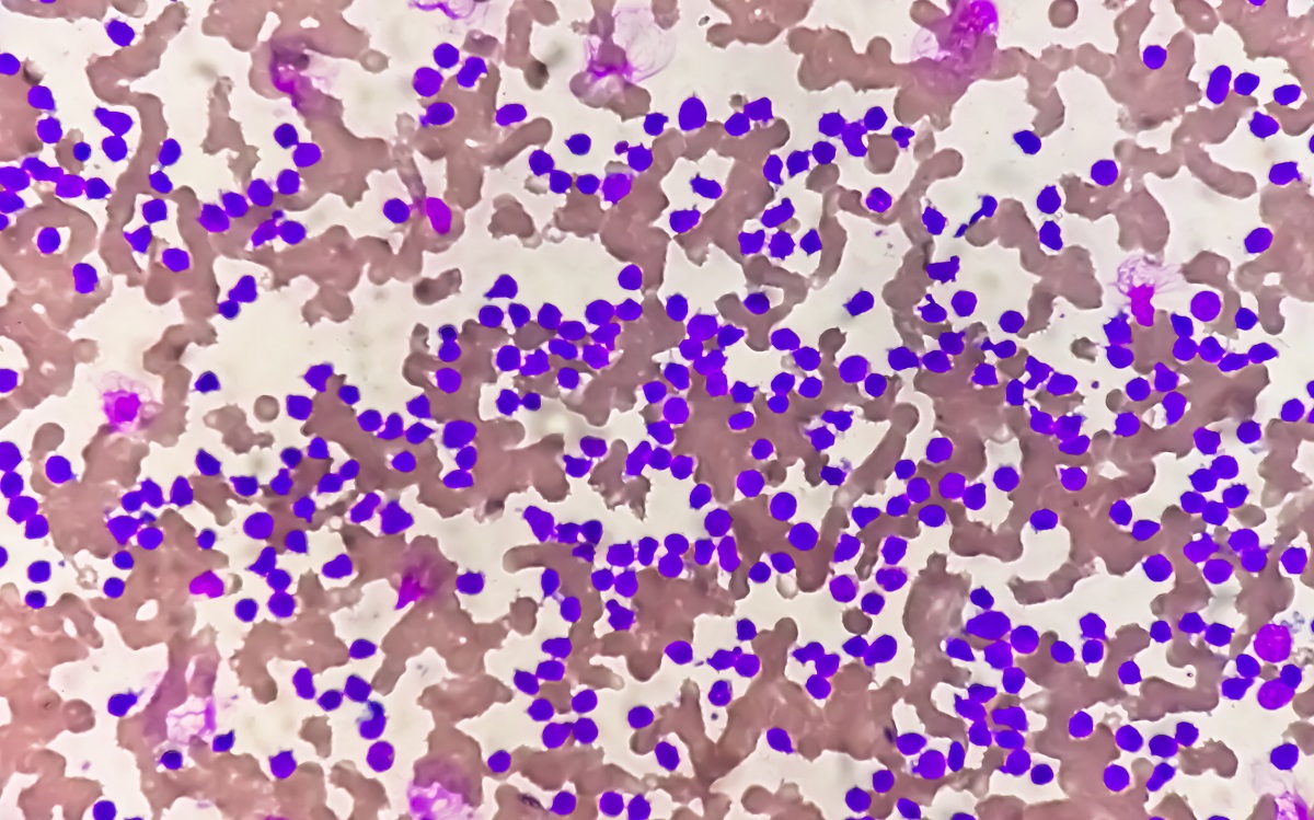 Chronic Myeloid Leukemia Cancer Cells